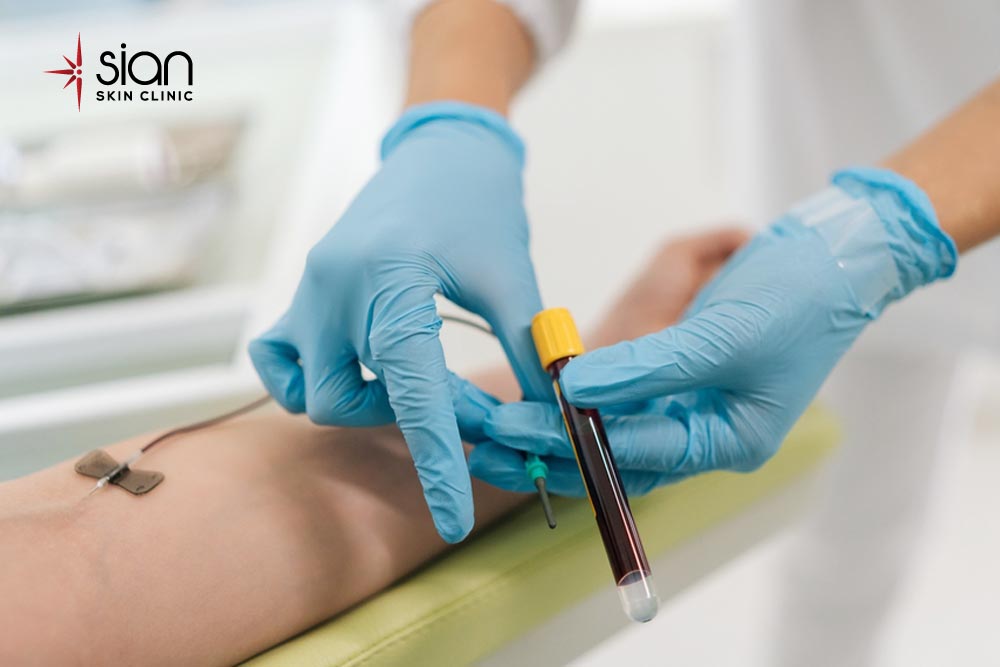 Pro Injection Meso PRP Injections – Many Benefits Can’t Be Ignored - SIAN Skin Clinic