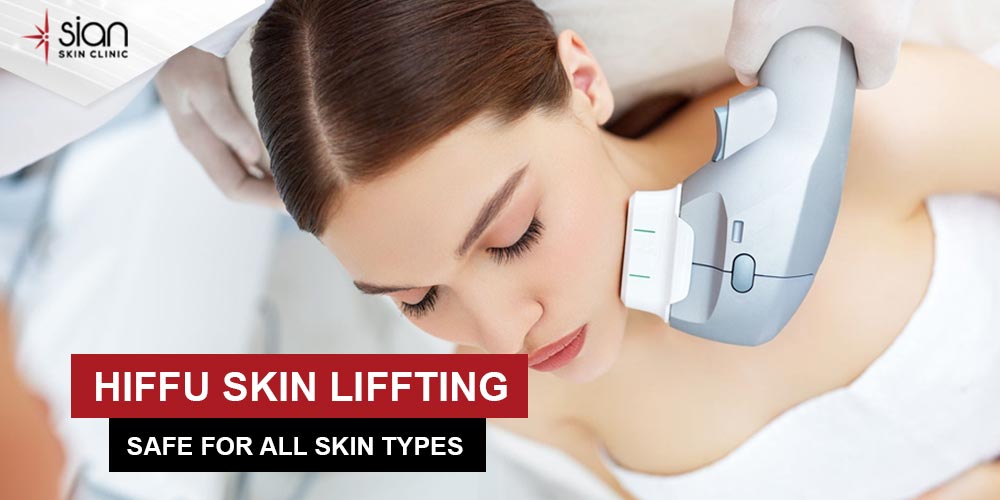 HIFU Skin Lifting treatment: High intensity Focused Ultrasound Therapy