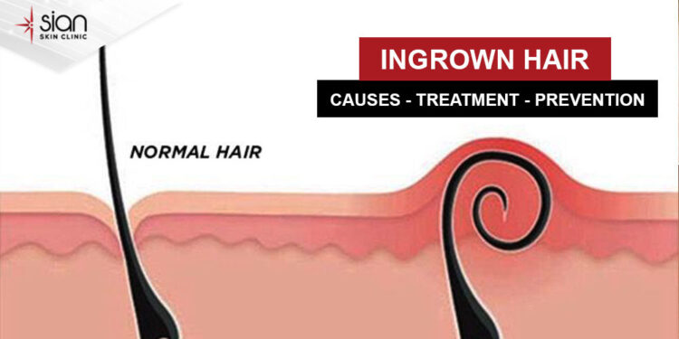 Ingrown hairs his can cause the skin to become inflamed, irritated, and occasionally infected