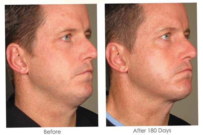 Before and after double chin treatment for men with Ultherapy Prime
