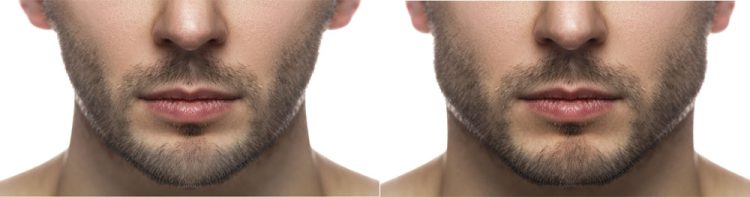 Jawline filler for men strengthens facial contours for a powerful look