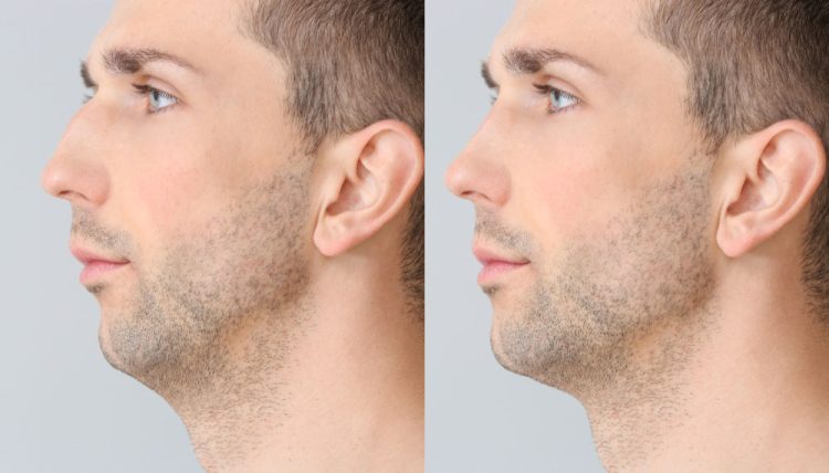 Achieve a well-balanced, defined look with male jawline filler.