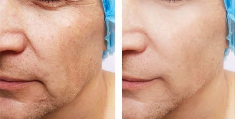 Cheek filler for men before after