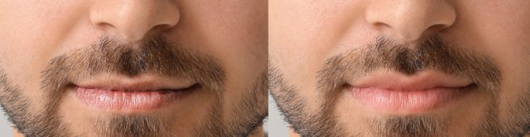 Lip filler injections for men before after