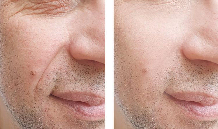 Smile line filler injections for men before after