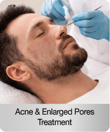 acne-treatment-for-men