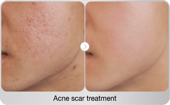 before-after-acne-scar-treatment