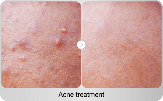before-after-acne-treatment