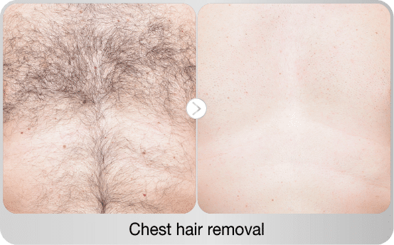 before-after-chest-hair-removal