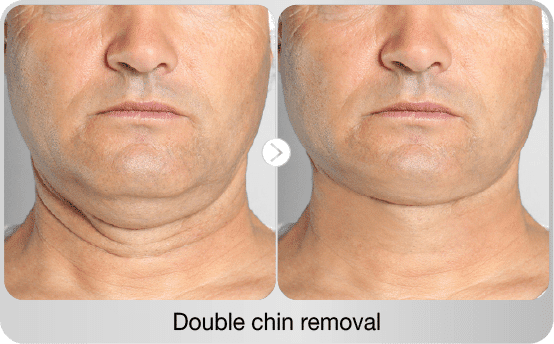 before-after-double-chin-removal