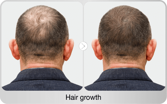 before-after-hair-growth