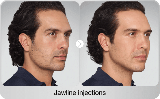 before-after-jawline-injections