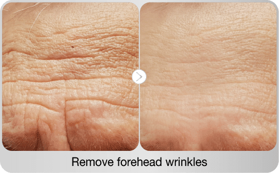 before-after-remove-forehead-wrinkles