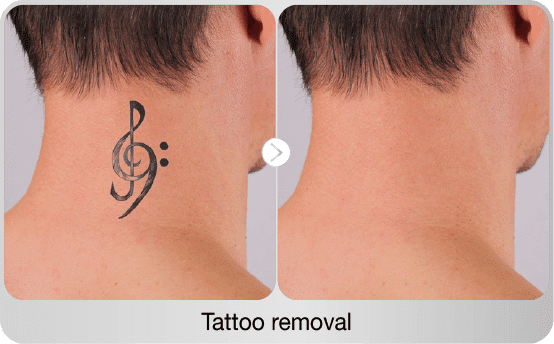 before-after-tattoo-removal