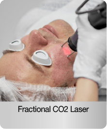 fractional-co2-laser-for-men