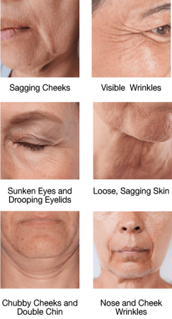 ultherapy-treatment-issues