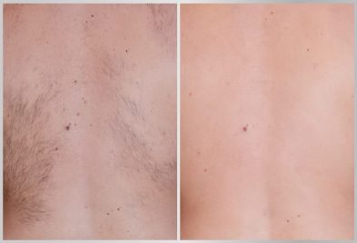 before-after-back-hair-removal-treatment