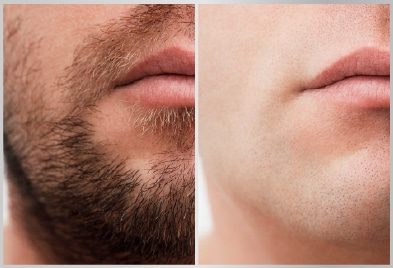 before-after-beard-hair-removal-treatment