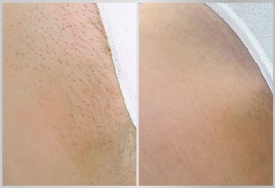 before-after-brazilian-hair-removal-treatment