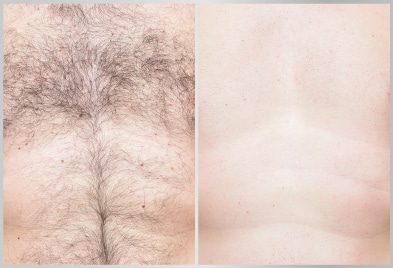 before-after-chest-hair-removal-treatment
