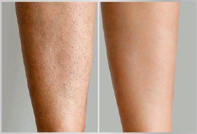 before-after-legs-hair-removal-treatment
