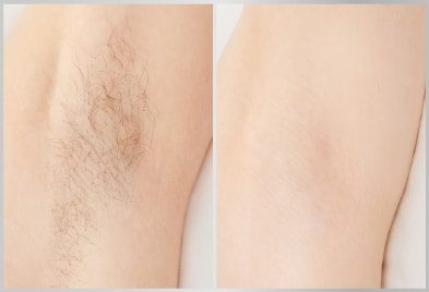 before-after-under-arm-hair-removal-treatment